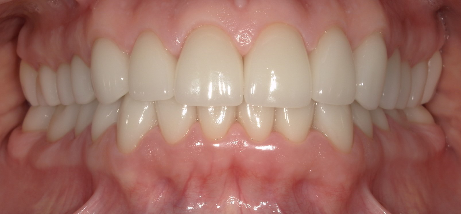 After Treatment After Treatment